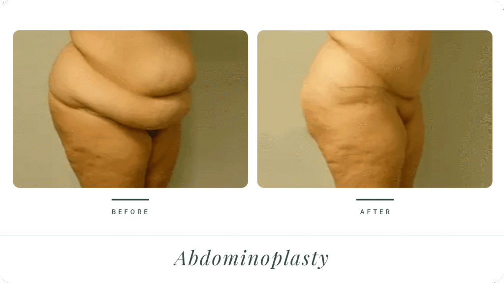 Abdominoplasty-3-LT