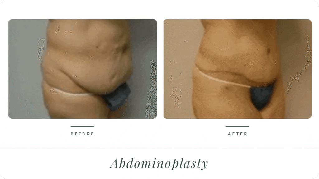 Abdominoplasty-LT