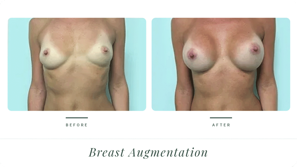 Breast-Augmentation-LT