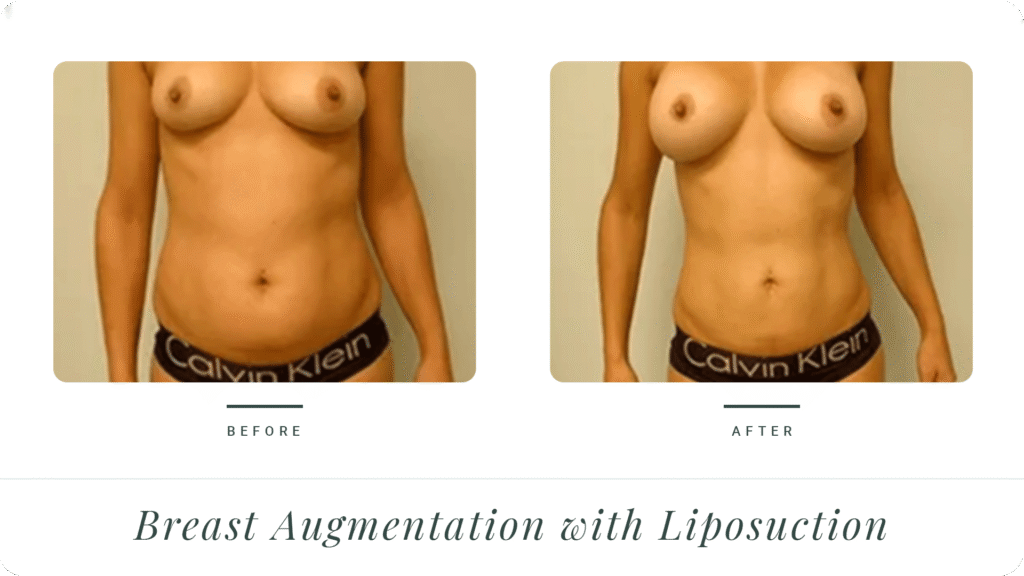 Breast-Augmentation-&-liposuction-LT