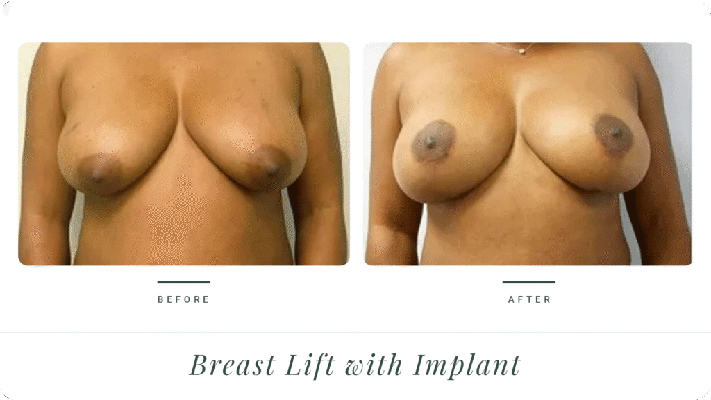 Breast-Life-&-Implant-LT