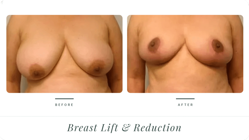 Breast-Lift-&-Reduction-2-LT
