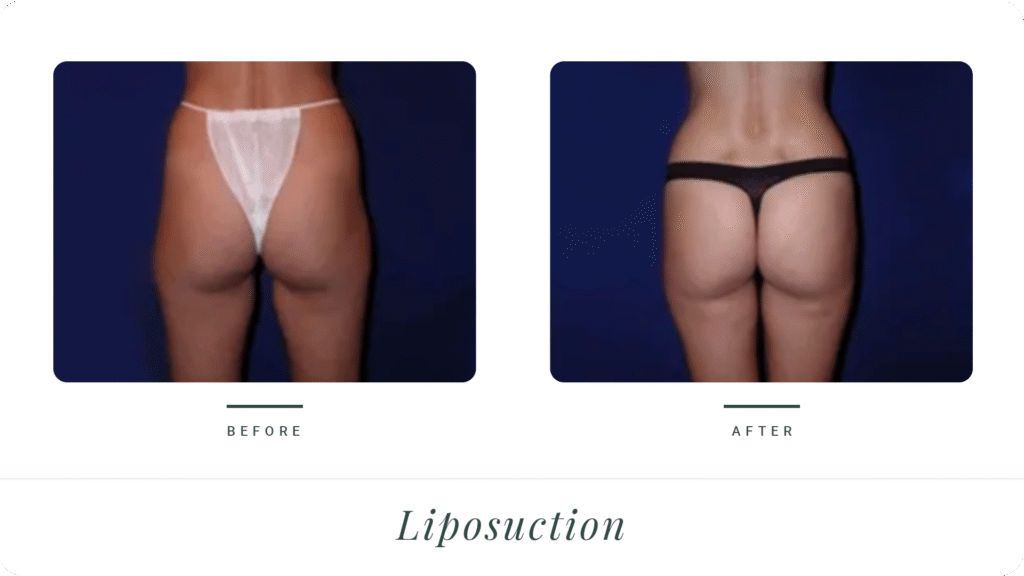 Liposuction-2-LT